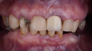 dental-implants-in-turkey-2