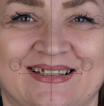 dental-implants-in-turkey-3