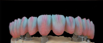 dental-implants-in-turkey-5