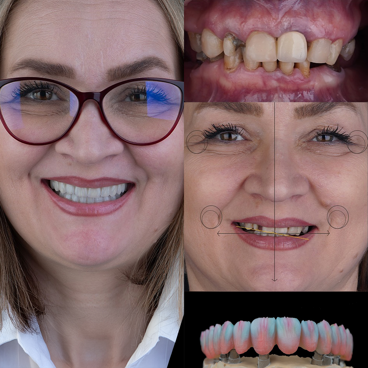 Dental Implants in Turkey