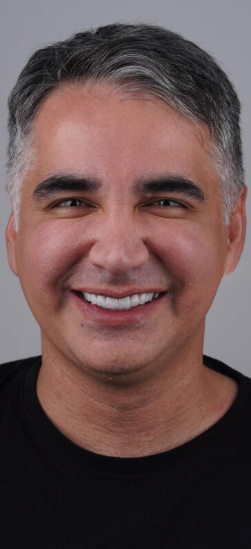 emax-crowns-in-turkey-1