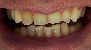 emax-crowns-in-turkey-2