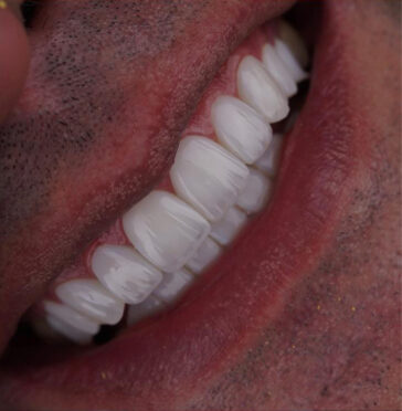 emax-crowns-in-turkey-3