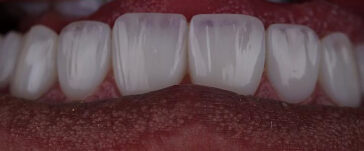 emax-crowns-in-turkey-4