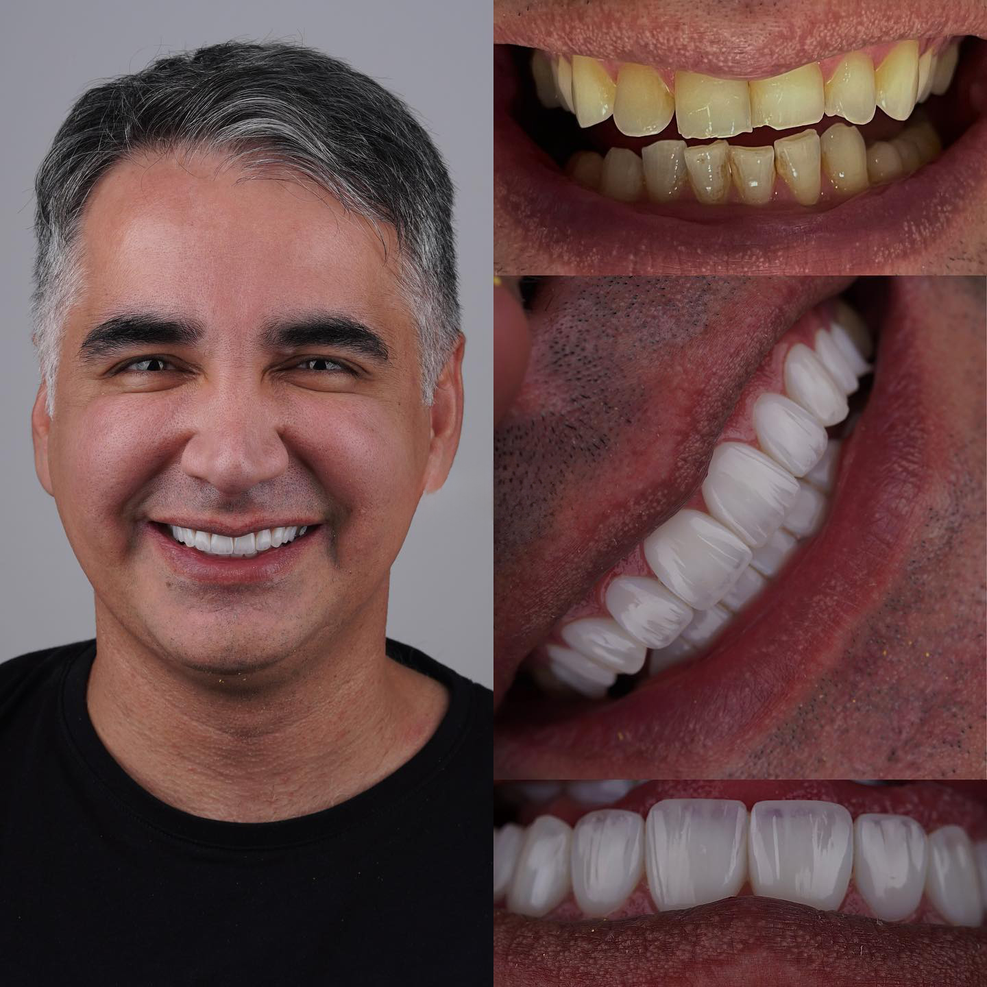 E-MAX Crowns in Turkey