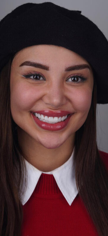 hollywood-smile-in-turkey-1