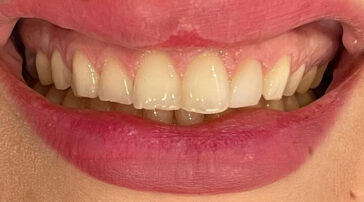 hollywood-smile-in-turkey-2