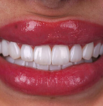 hollywood-smile-in-turkey-3