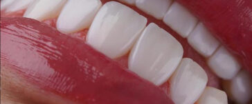 hollywood-smile-in-turkey-4