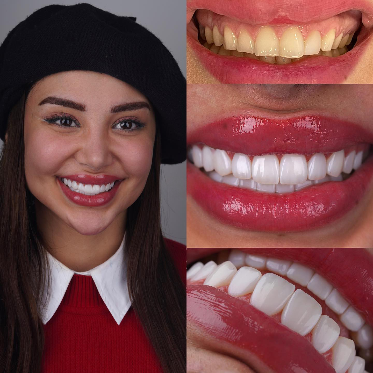 Hollywood Smile in Turkey