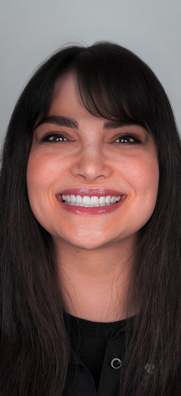 laminate-veneers-in-turkey-1