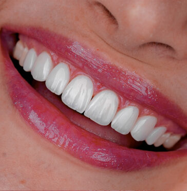 laminate-veneers-in-turkey-3