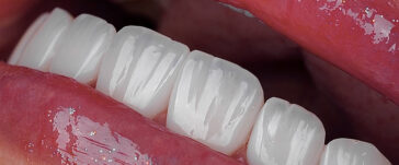 laminate-veneers-in-turkey-4