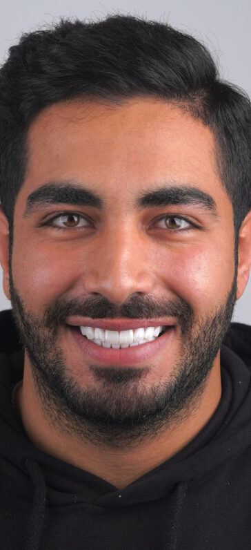 zirconium-crowns-in-turkey-1