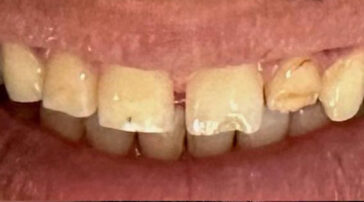 zirconium-crowns-in-turkey-2