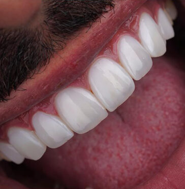 zirconium-crowns-in-turkey-3