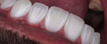 zirconium-crowns-in-turkey-4