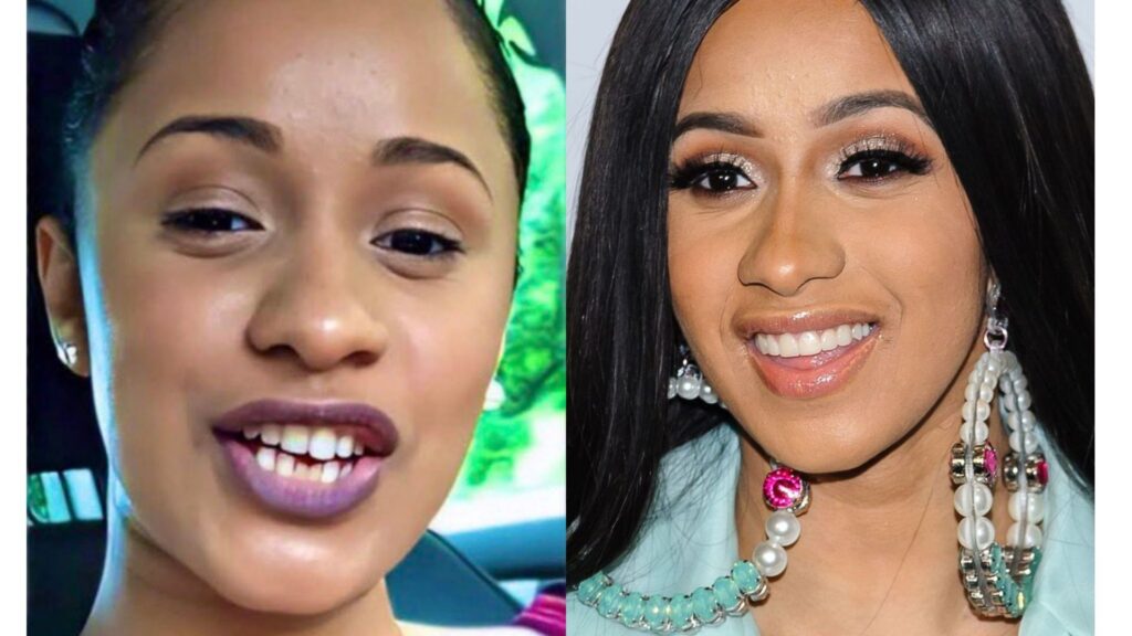 Cardi B Teeth Transformation