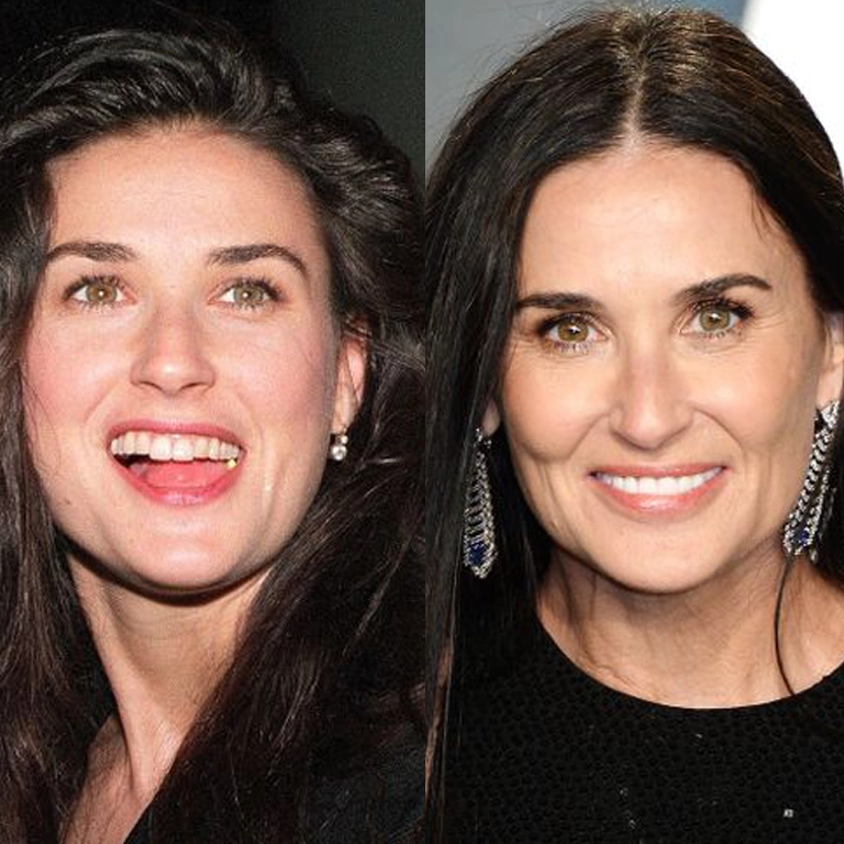 demi moore teeth