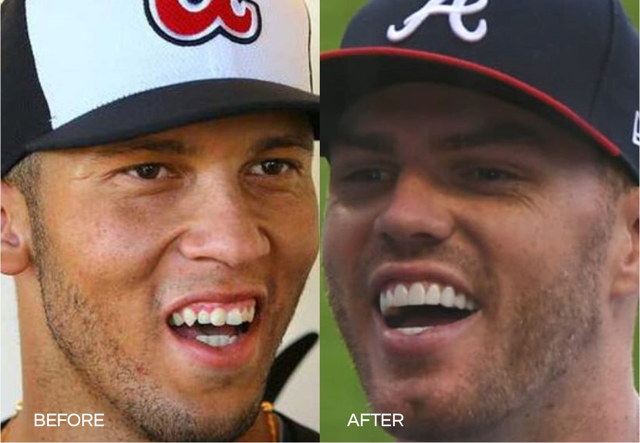 freddie freeman teeth